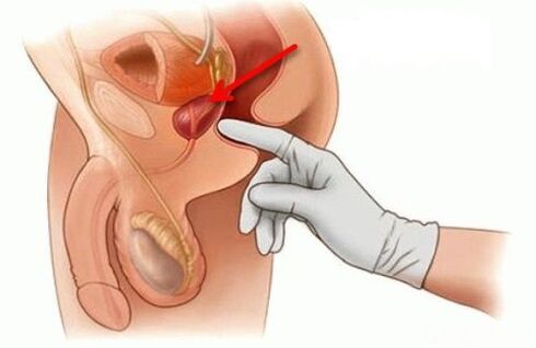 masaj de prostată pentru prostatită
