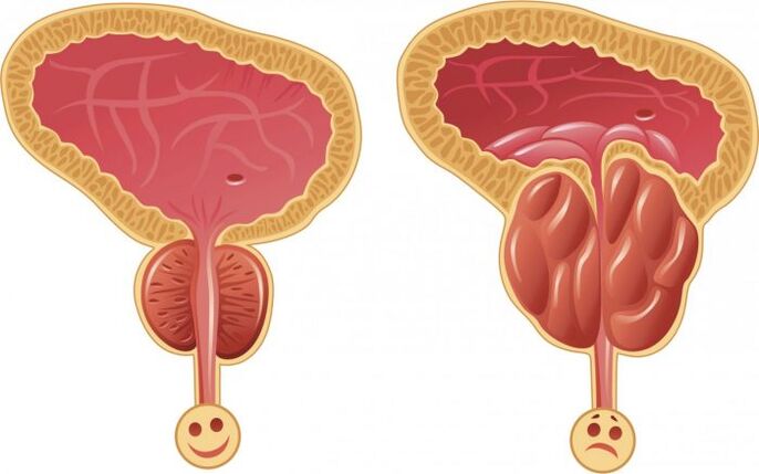 prostată sănătoasă și inflamată cu prostatita